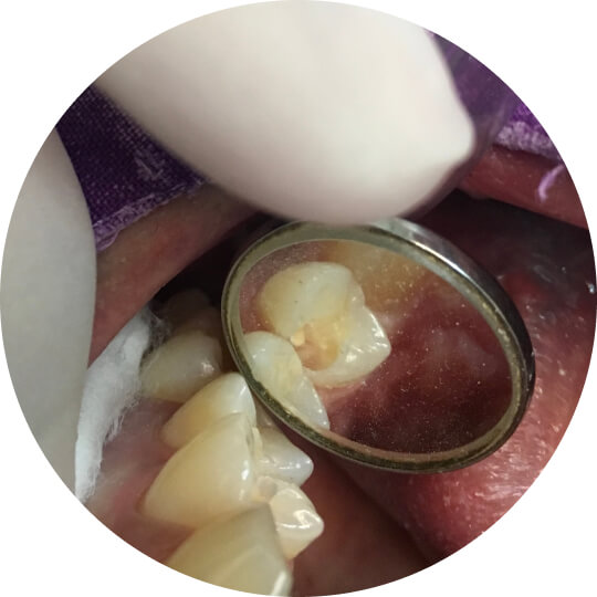 A tooth with a hole reflected in a small dental mirror held by gloved fingers